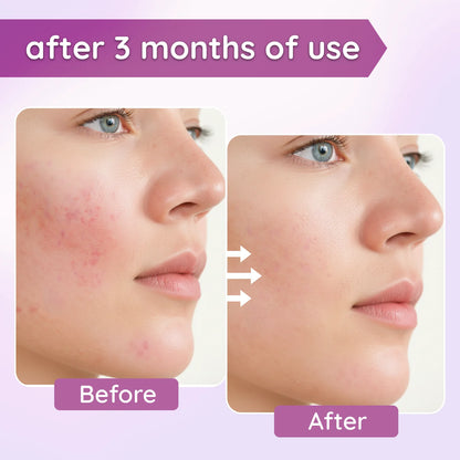 Inare Led Light Facial Device